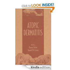 Atopic Dermatitis Thomas Bieber, Donald Y. M. Leung  