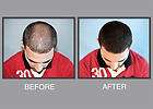 Mira Hair Oil   GROW HAIR Stop Baldness Thin Hair Growth ALOPECIA DHT
